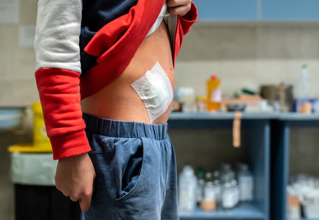 Rakovina slepého čreva v ranom štádiu napodobňuje nekomplikovanú apendicitídu. (zdroj: Adobe Stock)