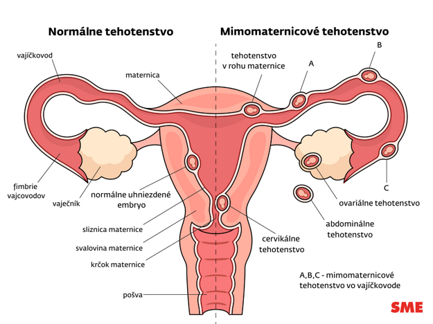 Normálne a mimomaternicové tehotenstvo. (zdroj: SME)