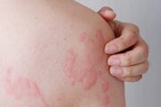 Akútna žihľavka ako alergická reakcia sa obvykle objavuje u detí a mladistvých.