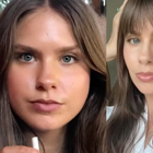Influencerky si samodiagnostikujú "kortizolovú tvár".