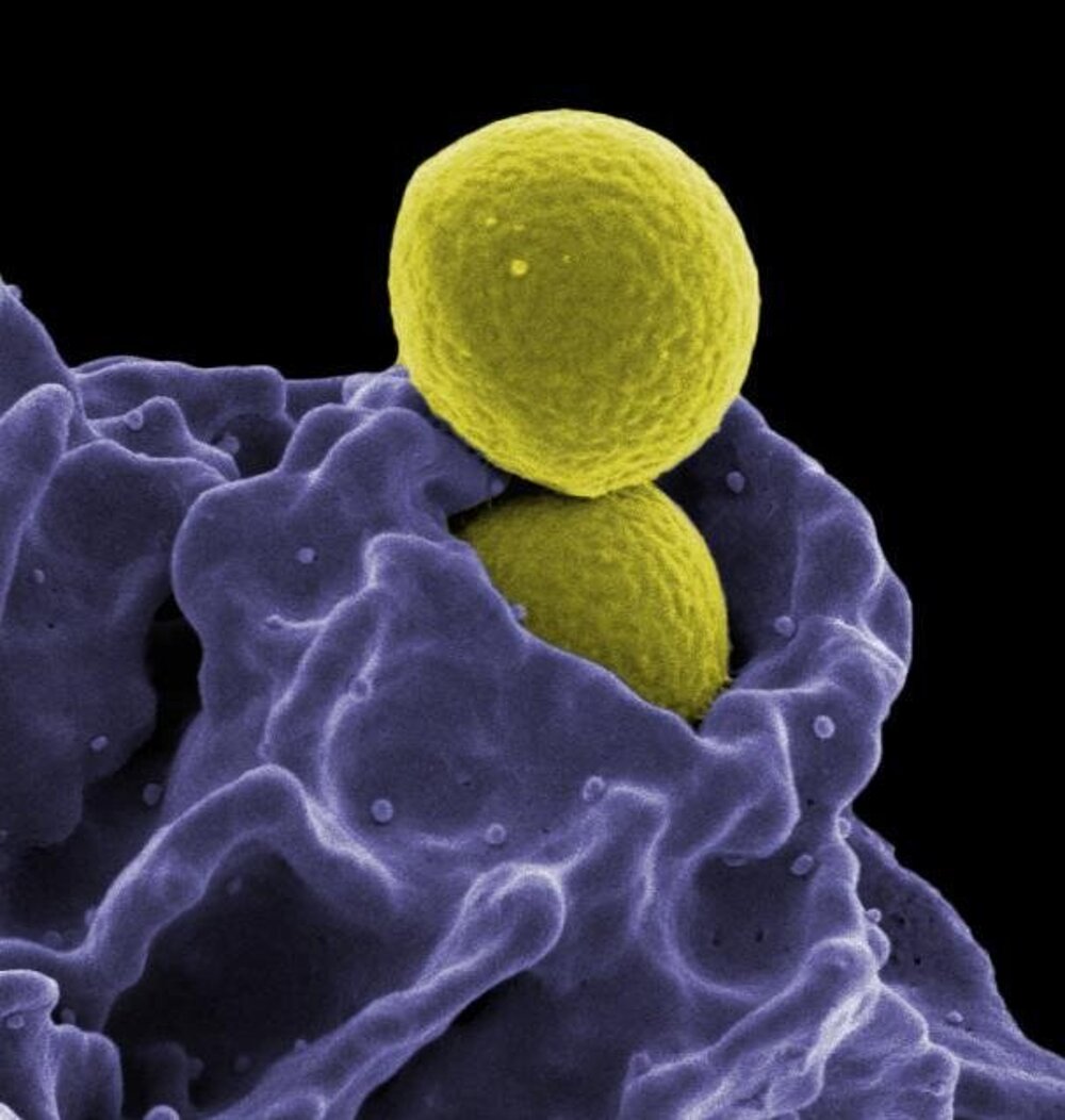 Neutrofil (fialový) požiera MRSA, odolný druh baktérie zlatého stafylokoka.
