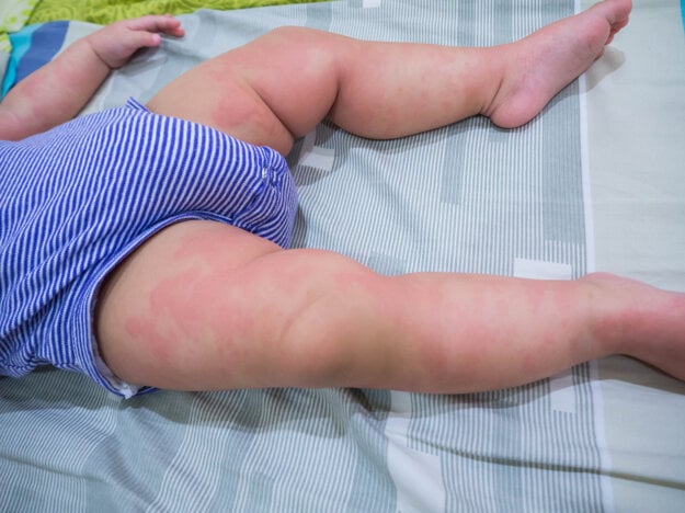 Alergie sú jednou z najčastejších príčin žihľavky u detí. (zdroj: Adobe Stock)