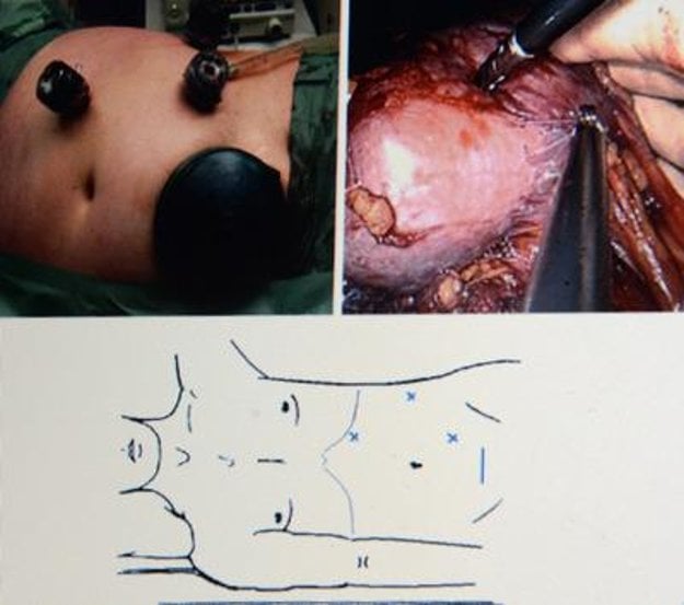 Laparoscopic kidney transplant explained at the press conference