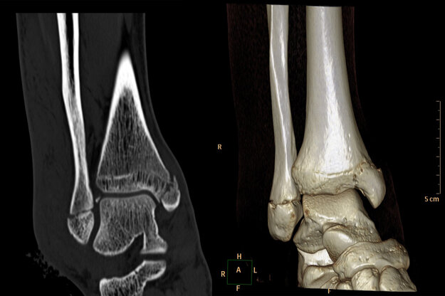 CT zlomeniny členka po úraze na trampolíne