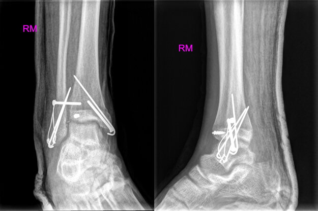 Pooperačný snímok po ošetrení zlomeniny.